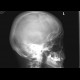 Fissure of the occipital bone: X-ray - Plain radiograph